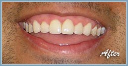 Picture of smile after dental veneers