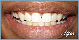 Picture of smile after dental veneers