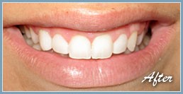 Picture of smile with dental veneers