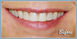 Picture of smile before dental veneers