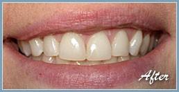 After picture of veneers