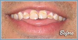 Picture of smile before veneers
