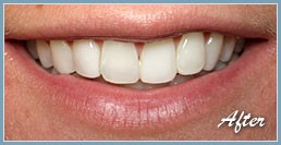 Picture of smile after dental veneers