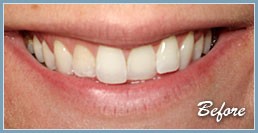 Picture of smile before dental veneers