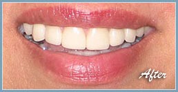 Picture of smile after dental veneers