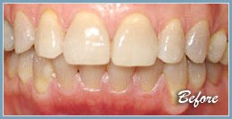 Picture of smile before dental veneers