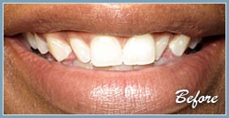 Picture of smile before dental veneers