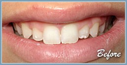Picture of smile before dental veneers