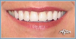 Picture of smile after dental veneers