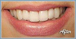 Picture of smile after dental veneers