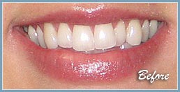Picture of smile before dental veneers