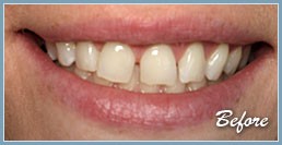 Picture of smile before dental veneers