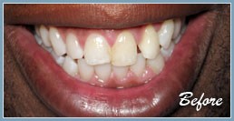 Picture of smile before dental veneers