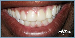 Picture of smile after dental veneers
